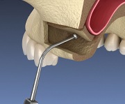 diagram of a sinus lift for advanced implant procedures