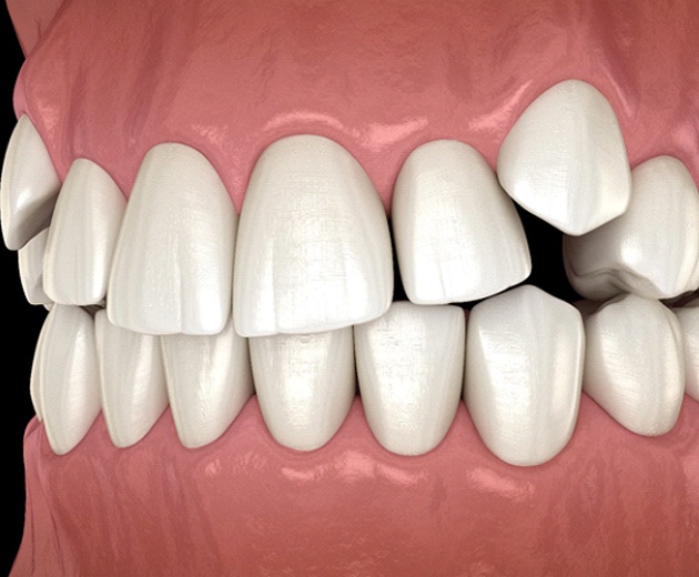 Illustration of partially erupted canine teeth against dark background